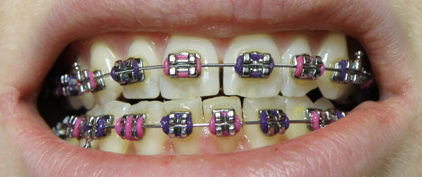 braces mouthguard