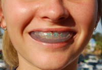 Braces mouthguard