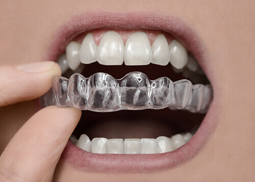Teeth Whitening Trays